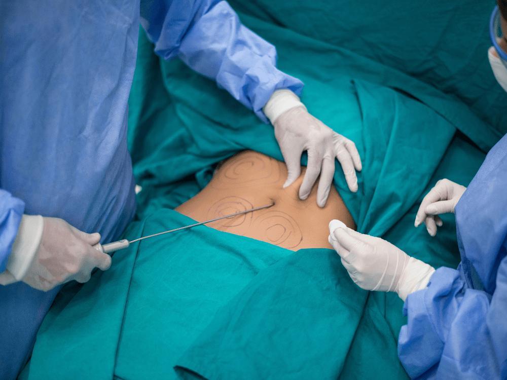 O que é dreno na cirurgia médica 
